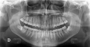 Digital Intraoral X-rays are a common practice to help residents of Kenosha and Paddock Lake maintain oral health.